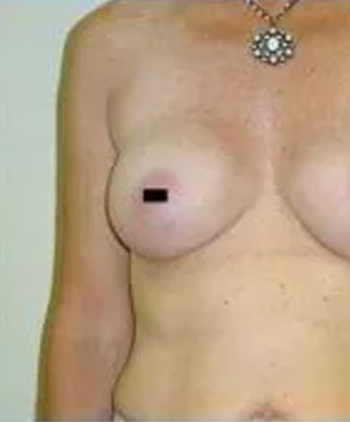 A person's torso with a breast, nipple covered by black bar, and a necklace.