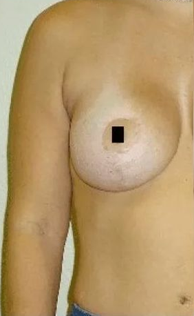 Person's upper body with a bare breast and arm. Nipple is covered with a black square.
