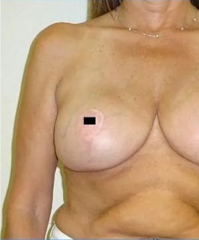 Torso of a person, possibly post-surgical. A small black square covers part of a breast.