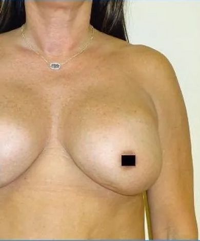 Woman's bare chest with one nipple obscured by a black square. She wears a necklace.