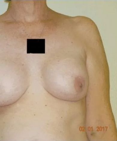 Woman's bare chest with one visible nipple. Black square covers a portion of the chest. Date stamp in bottom right.