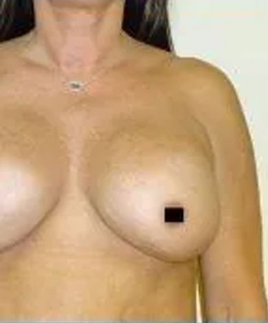 Woman's torso, wearing a necklace. Breasts visible; one nipple covered with a black square.