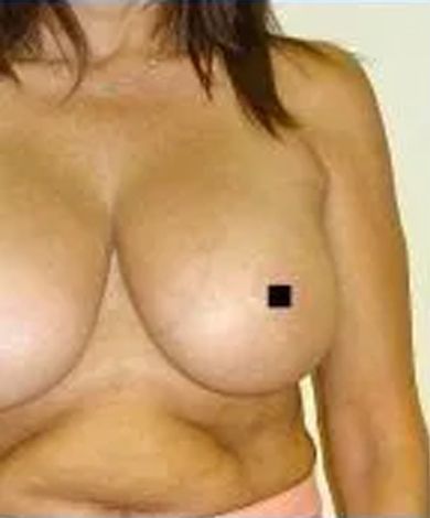 Nude torso, skin tone breasts, small black square covering a nipple.