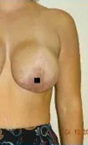 Woman's bare chest and shoulder; dark square covers nipple.
