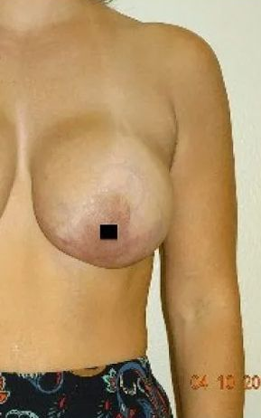 Woman's bare chest; one breast visible. Skin-toned background. Date stamp: 04 12 2017.
