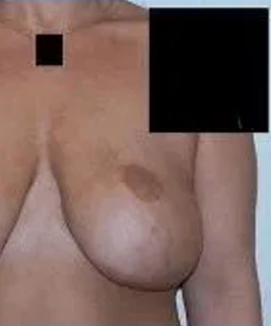 Torso of a person with visible breasts, one obscured by a large black square.