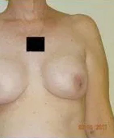 Torso of a person with a breast partially visible. The person has fair skin.