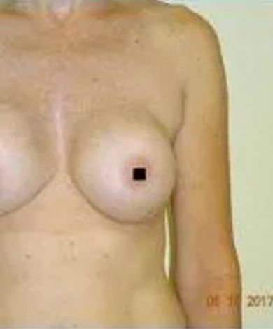 Torso with a breast that has a small black square covering the nipple. The skin is pale.