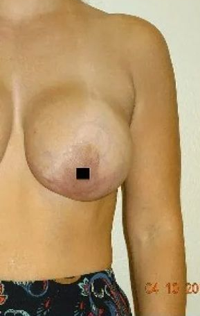 Torso of a person, breasts exposed, black square covering the nipple.