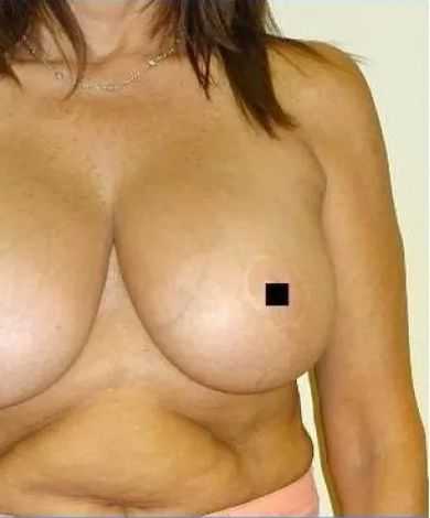 Torso of a person, nude from the shoulders down, with breasts; a small black square is over the right nipple.