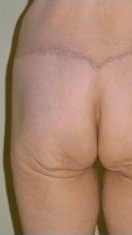 Buttocks and upper thigh with visible surgical scar.
