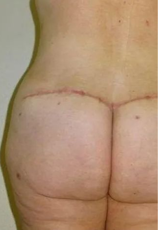 Buttocks and lower back showing a horizontal surgical scar.