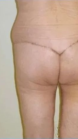 Rear view of a person's legs, likely after surgery; outline visible on the buttocks area.