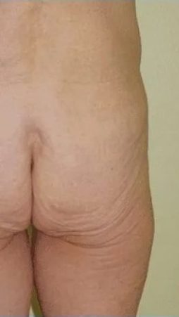 Side view of a person's torso and buttocks, showing wrinkled skin and folds. Neutral beige backdrop