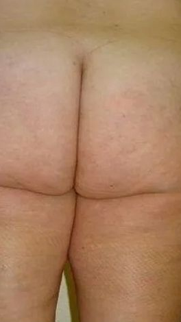 Buttocks with visible cellulite. Beige skin tone