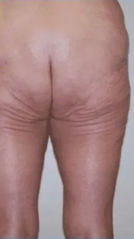Buttocks and legs, showing skin with prominent wrinkles and folds.