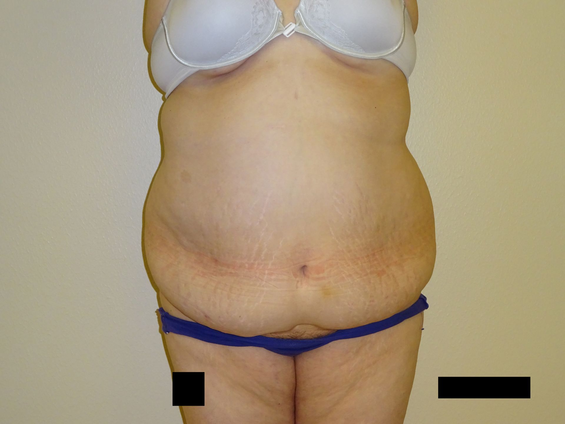 Torso of a person wearing a bra and blue underwear, showing visible skin folds and stretch marks on the abdomen.