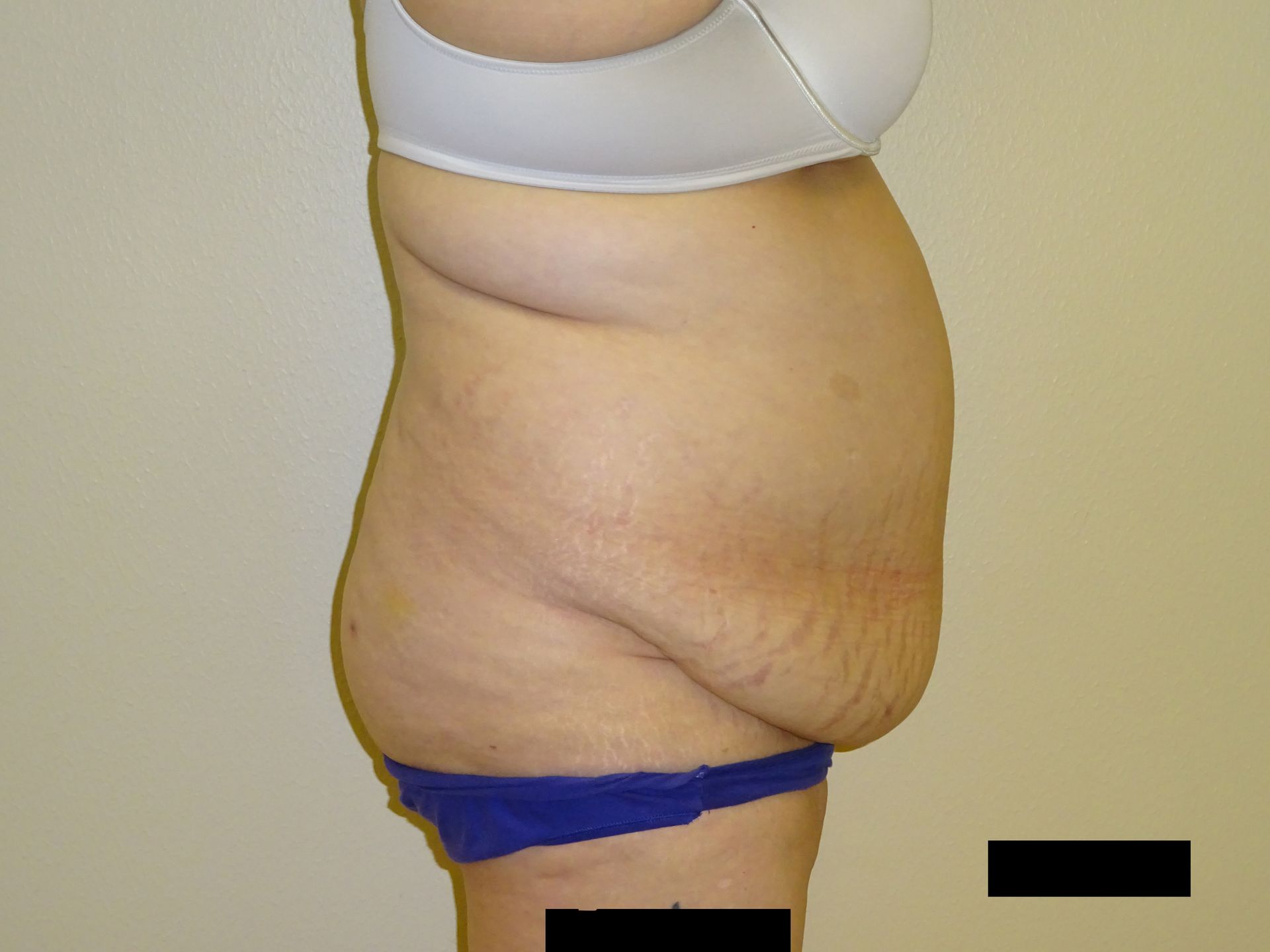Side view of a person wearing a bra and blue underwear, showing loose skin and stretch marks on abdomen.