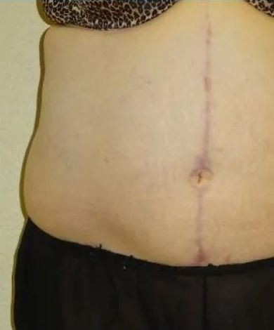 Abdomen with a vertical surgical scar. Skin is light with dark clothing visible at the bottom and bra above.