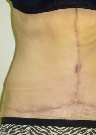 Torso with surgical scars: vertical mid-abdomen and horizontal below belly button. Light skin, wearing black bra and zebra-striped underwear.