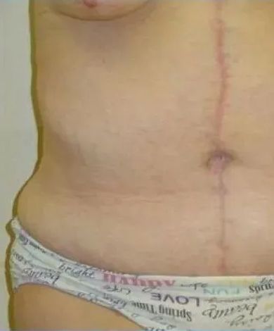 Torso with surgical scar from chest to abdomen, wearing patterned underwear.