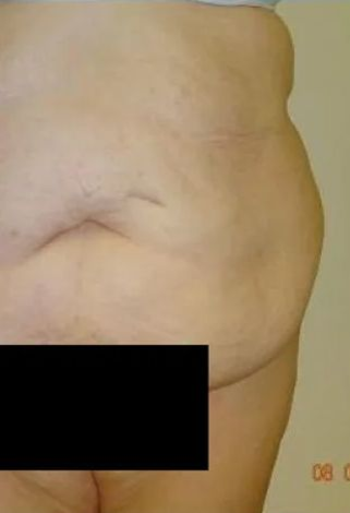 Side view of a person's torso and lower body, with visible skin folds and a blacked-out area.