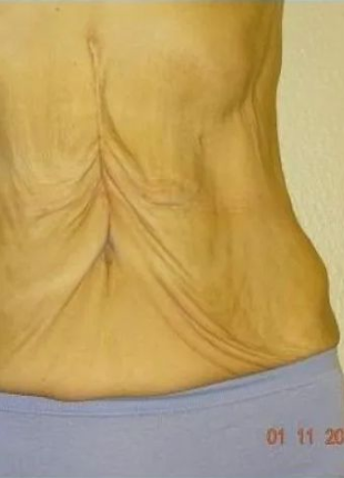 Wrinkled skin on abdomen and waist, with surgical scar visible. Wearing blue underwear, against light yellow wall.