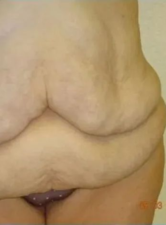 Abdomen with excess skin folds. Visible from the side, with loose skin. Light skin tone.