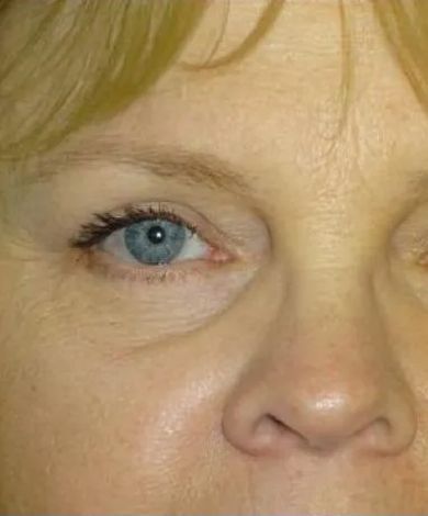 Close-up of a person's eye with blue iris, visible wrinkles around the eye, and a portion of the nose.