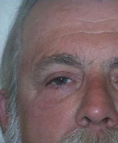 Close-up of a person's face. Shows one open eye, a mustache, and graying hair. The skin is fair with some redness.