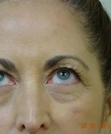 Close-up of a person's eyes, looking upwards. Visible wrinkles and slight bags under the eyes; blue eyes.