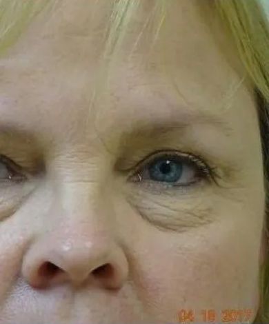 Close-up of a person's eye and nose. Blue eye, wrinkles around the eye.