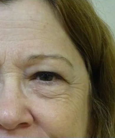 Close-up of a person's eye and face, showing wrinkles and skin texture.