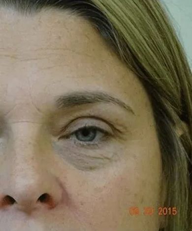 Close-up of a person's eye, showing wrinkles and dark circles under the eye.