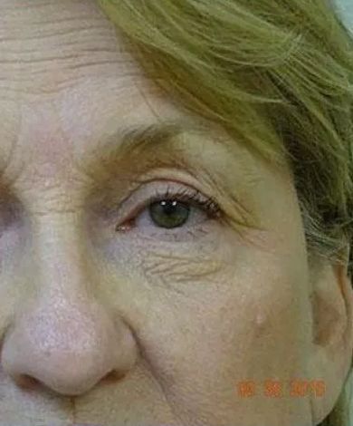 Close-up of a person's eye, showing wrinkles and a small bump on the cheek.