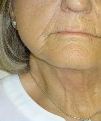 Close-up of a person's face and neck, showing wrinkles around the mouth and neck area.