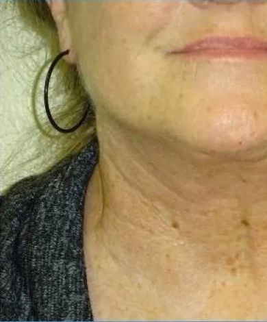 Close-up of a person's neck and jawline, showing wrinkles and some freckles.