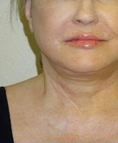 Close-up of a person's face and neck, with visible skin and wrinkles.