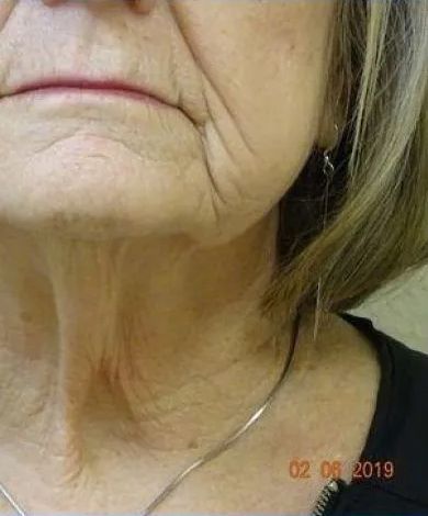 Close-up of a person's neck and lower face, showing wrinkles and skin aging.