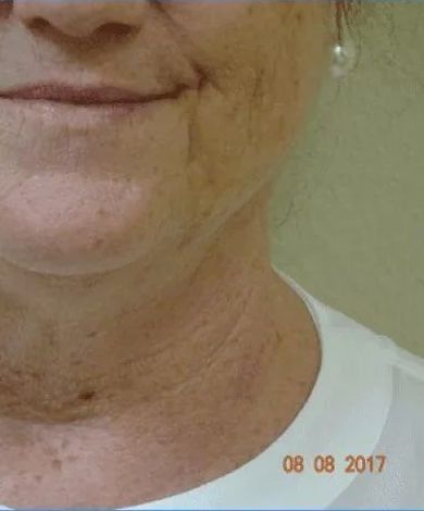 Close-up of a person's face and neck, with sunspots. Date stamp: 08 08 2017.