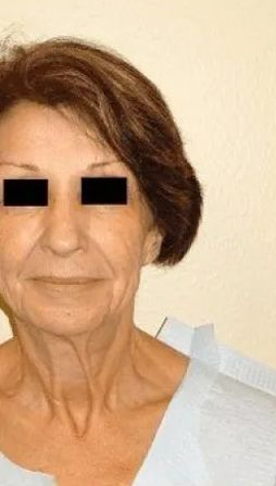 Woman with brown hair and neck wrinkles in a clinical setting; dated 01 11 2016.