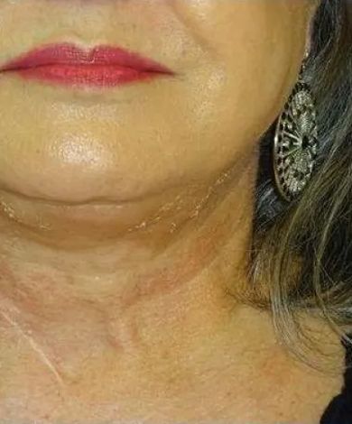 Close-up of a person's neck and chin, skin is wrinkled and a double chin is visible; they wear an earring.