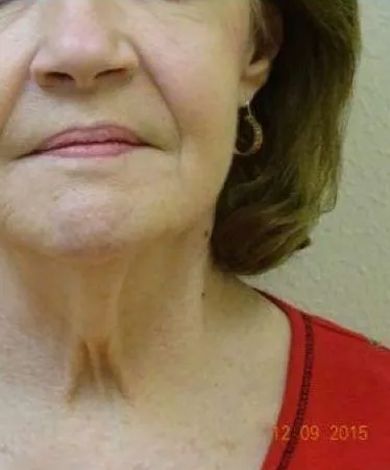 Close-up of a person's face and neck, with visible wrinkles and skin discoloration.