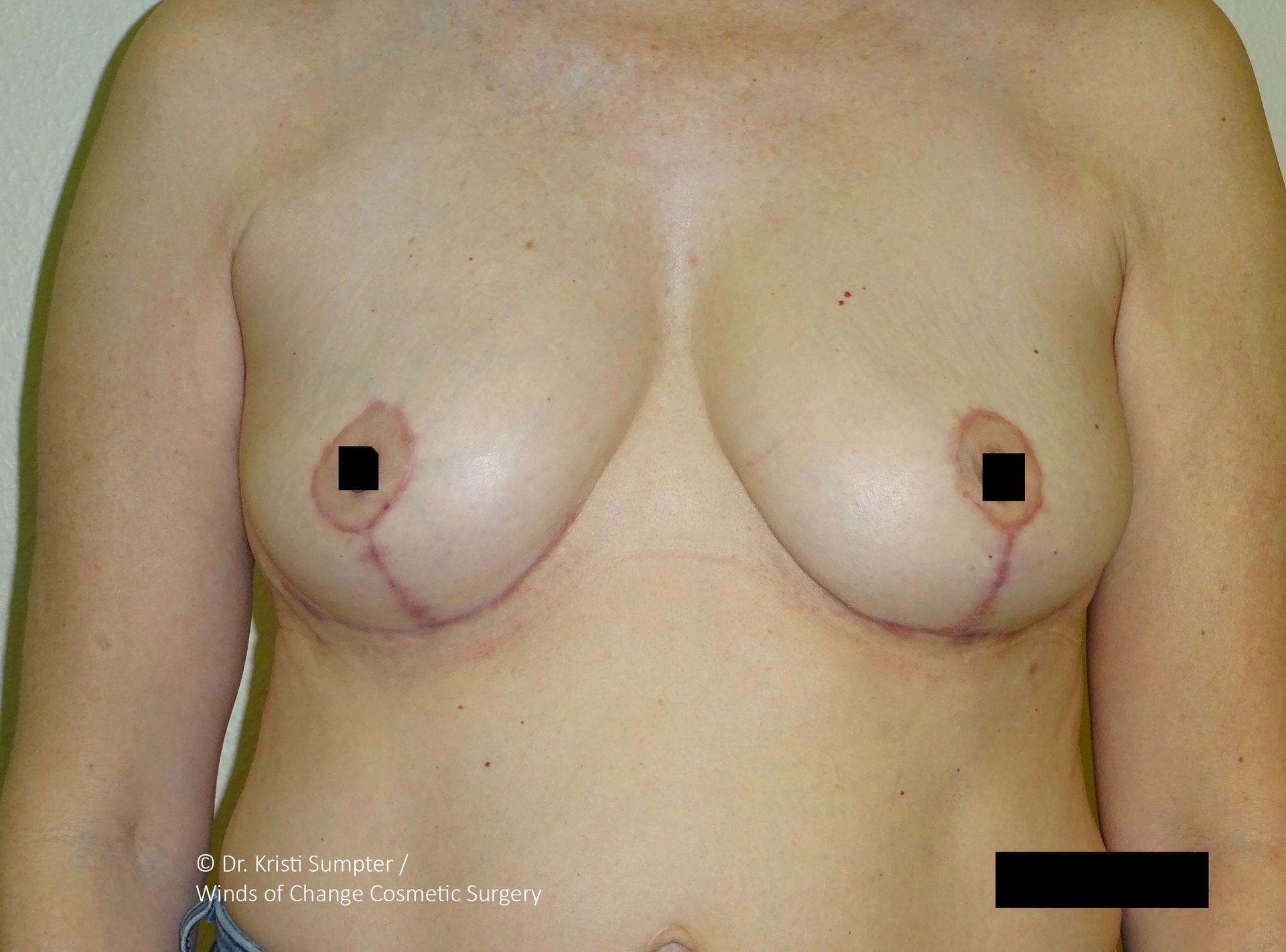 Breast reconstruction with visible surgical scars and marked nipples.