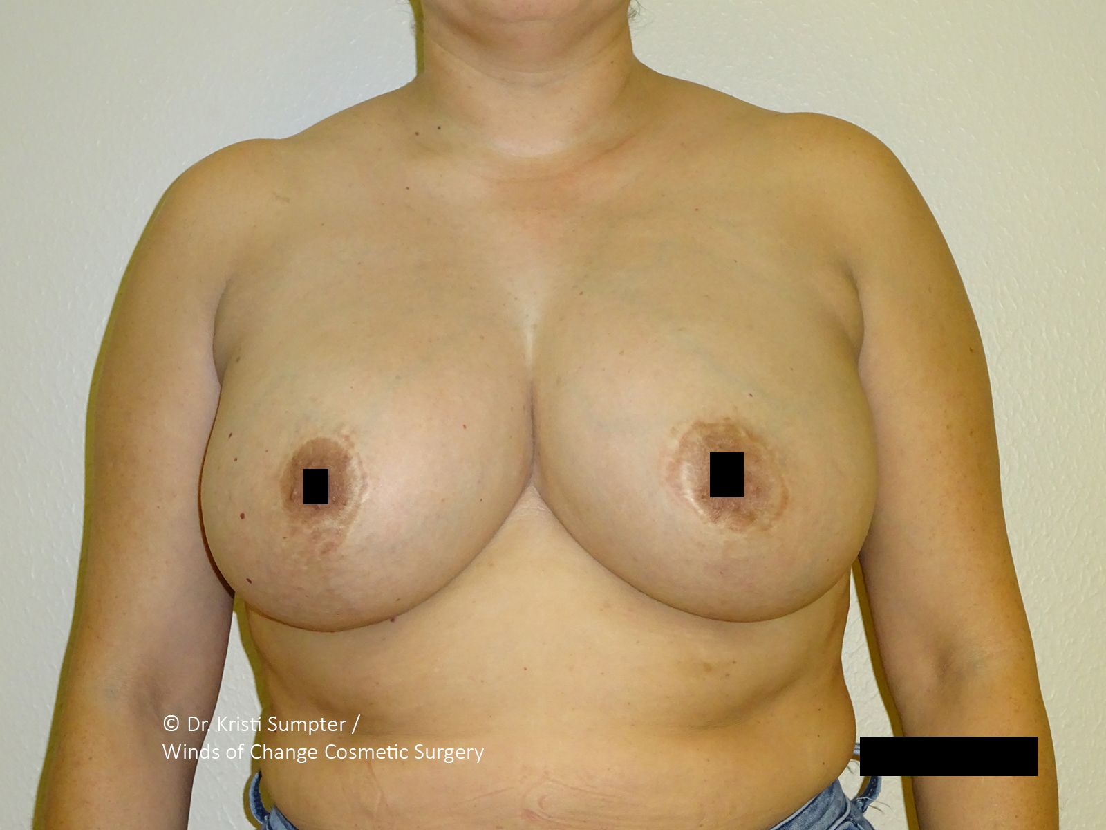 A person's torso, close-up, with breast and partially visible abdomen. The nipple is obscured. Skin is light-toned.