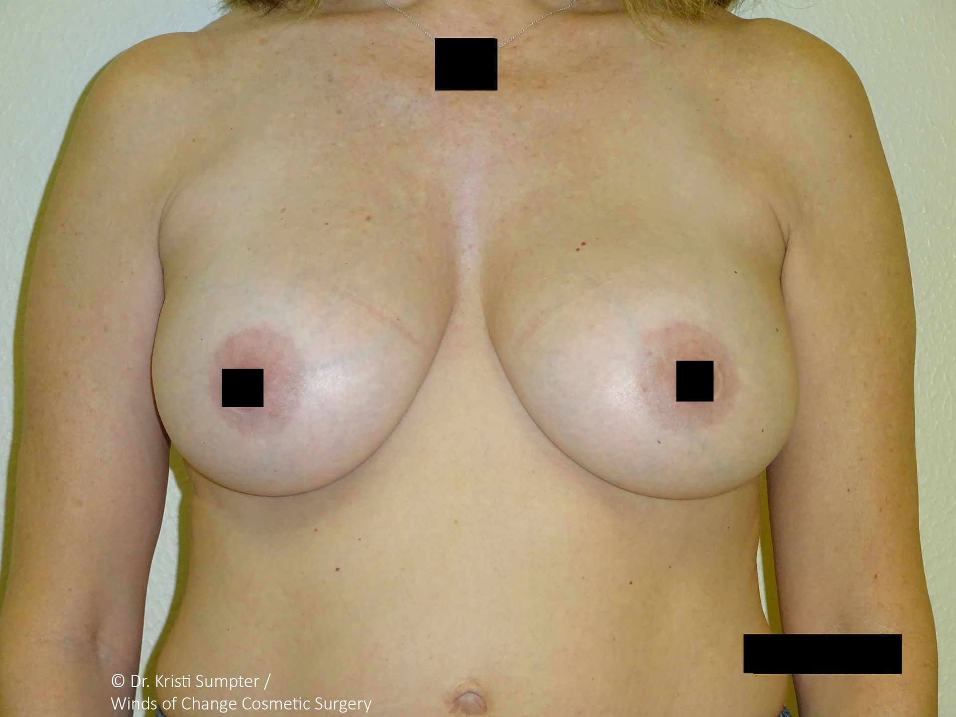 Woman's torso, frontal view, nude. Black squares obscure the nipples and other areas. Light skin tone.
