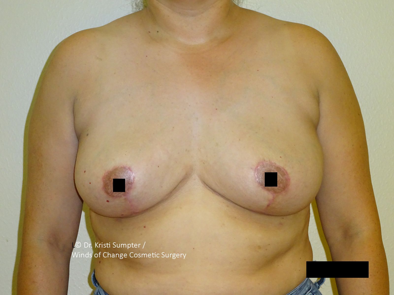A woman's bare chest; a darkened area on the nipple is obscured by a black box.