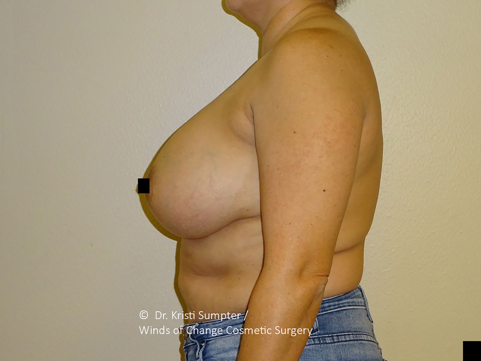 A close-up of a person's chest with one nipple obscured by a black square.