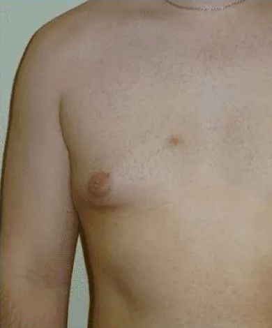 A person's chest, showing a prominent nipple and slight breast development. Skin is fair.