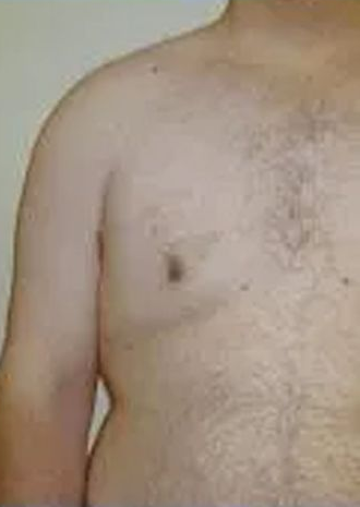 Upper torso of a person with visible body hair, arm hanging down, against a light background.